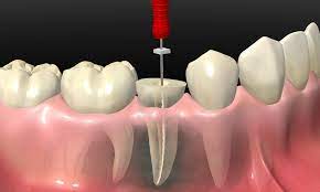 Endodoncia